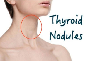 Thyroid Nodules Q & A - Health Solutions Plus